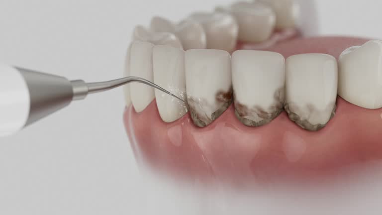 Reliable Tooth Extraction contractor in Fountain, CO by Smile Center Dentistry